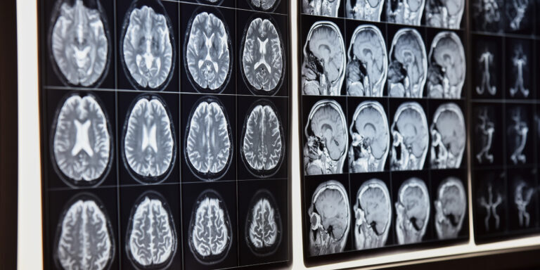 MRI scan van hersenen